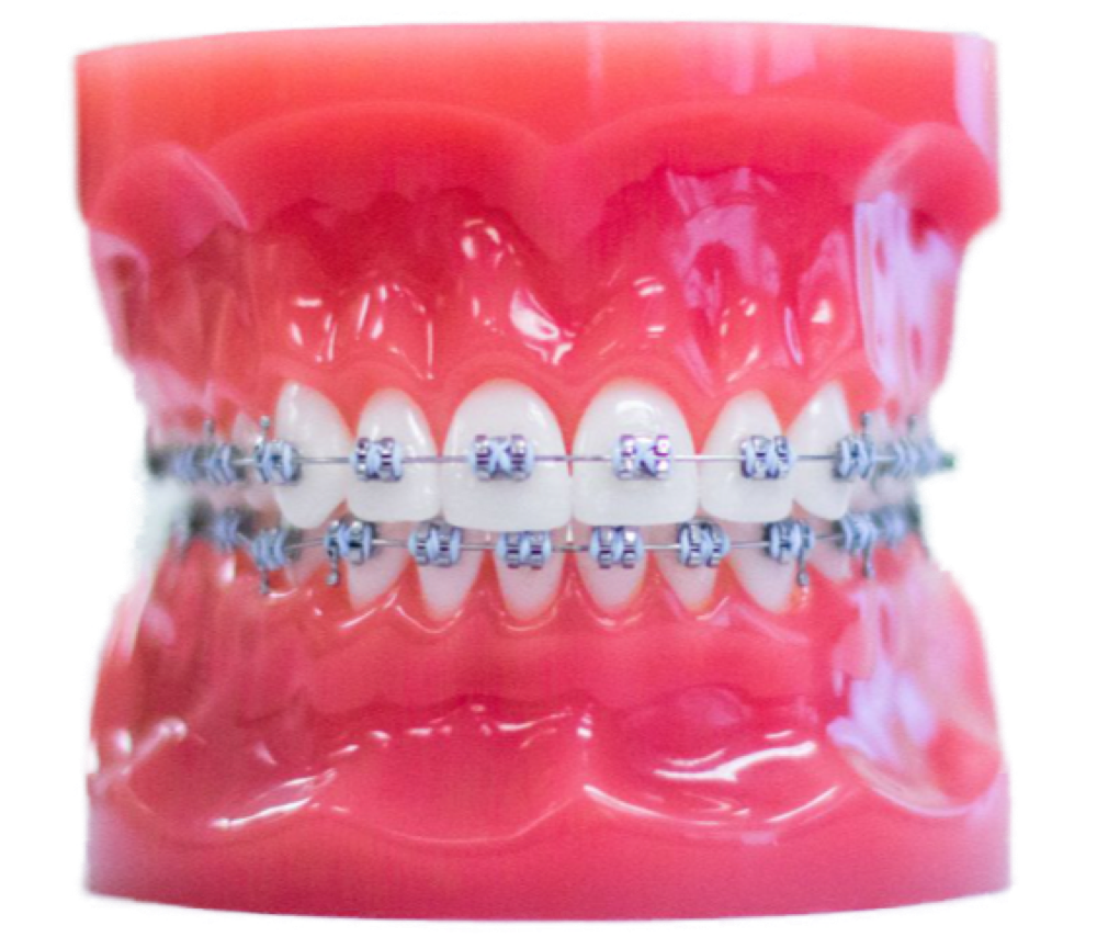 metal braces on plastic model